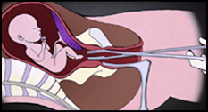 baby-dismembered-in-womb.png